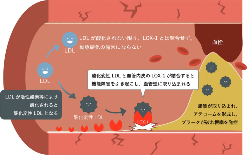 動脈硬化のメカニズム図