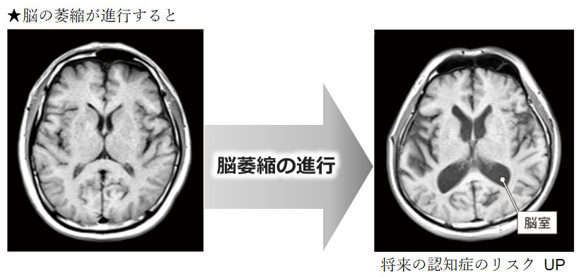 脳萎縮の進行プロセスと将来の認知症のリスクUP（脳室の拡大など）