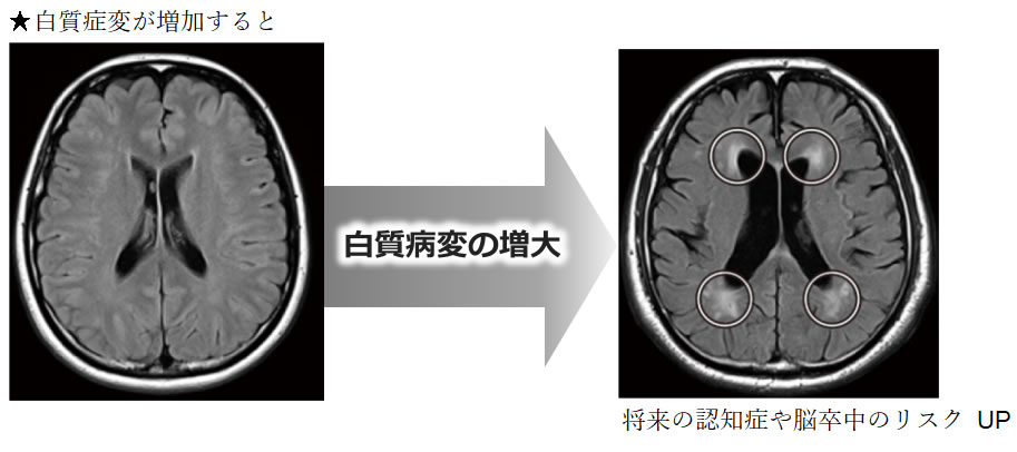 白質病変の増大プロセスと将来の認知症や脳卒中のリスクUP